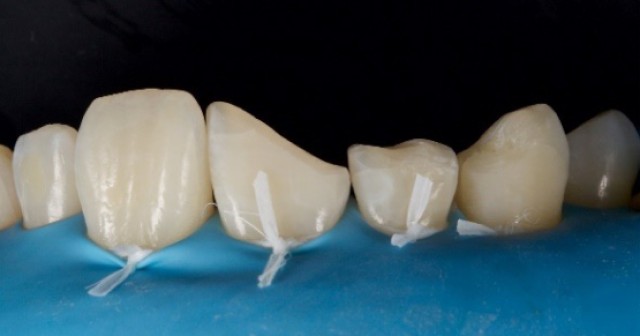 Rubber Dam in Dental Procedures, Part 3: Preparing Your Armamentarium