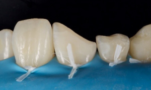 Rubber Dam in Dental Procedures, Part 3: Preparing Your Armamentarium Jason Smithson Rubber Dam Part 3 Fig 1