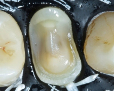 Rubber Dam in Dental Procedures, Part 3: Preparing Your Armamentarium Jason Smithson Rubber Dam Part 3 Fig 2