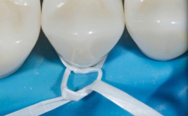 Rubber Dam Clamps, Floss Ties and Teflon Tape, Part 4