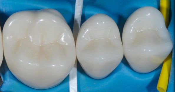 Rubber Dam Clamps, Floss Ties and Teflon Tape, Part 4 Jason Smithson Rubber Dams Part 4 fig1 e1757370979809