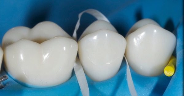 Rubber Dam Clamps, Floss Ties and Teflon Tape, Part 4 Jason Smithson Rubber Dams Part 4 fig2 e1757371102255