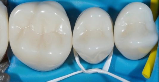 Rubber Dam Clamps, Floss Ties and Teflon Tape, Part 4 Jason Smithson Rubber Dams Part 4 fig3 e1757371011790