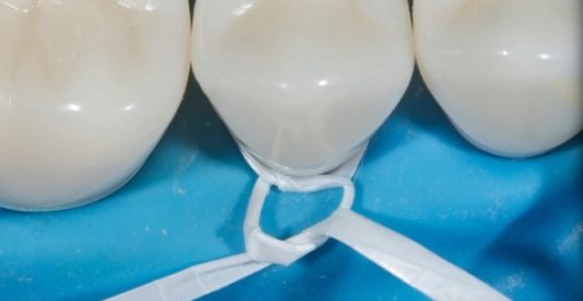 Rubber Dam Clamps, Floss Ties and Teflon Tape, Part 4 Jason Smithson Rubber Dams Part 4 fig4 e1757371398880