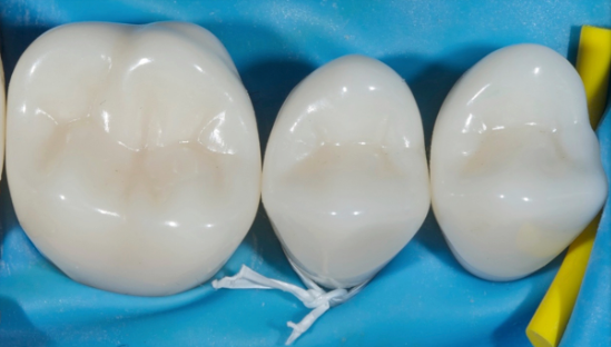 Rubber Dam Clamps, Floss Ties and Teflon Tape, Part 4 Jason Smithson Rubber Dams Part 4 fig5 e1757371433232