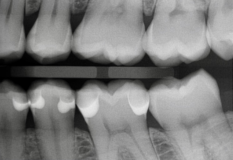 Rubber Dam Clamps, Floss Ties and Teflon Tape, Part 4 Jason Smithson Rubber Dams Part 4 fig7