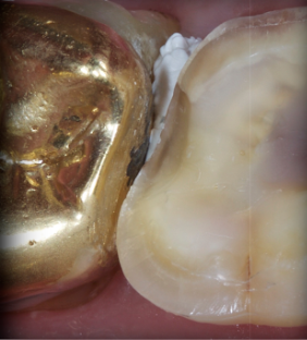 Rubber Dam Clamps, Floss Ties and Teflon Tape, Part 4 Jason Smithson Rubber Dams Part 4 fig8 e1757371048192