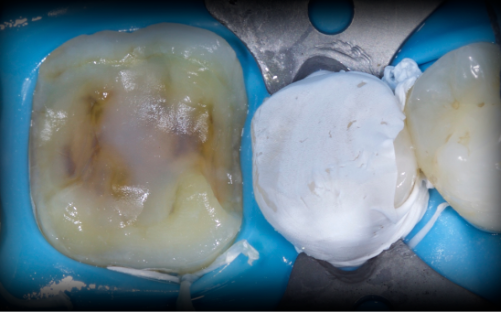 Rubber Dam Clamps, Floss Ties and Teflon Tape, Part 4 Jason Smithson Rubber Dams Part 4 fig9 e1757371033991