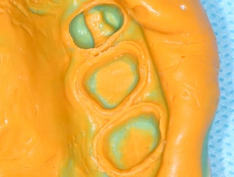 Jeff Lineberry The Double Cord Impression Technique Featured Image