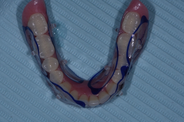 Guided Implant Placement For the Edentulous Arch — Dual Scan Technique JeffLineberry guided implant placement for the edentulous arch dual scan technique Fig.1