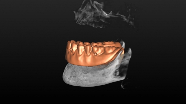 Guided Implant Placement For the Edentulous Arch — Dual Scan Technique JeffLineberry guided implant placement for the edentulous arch dual scan technique Fig.2