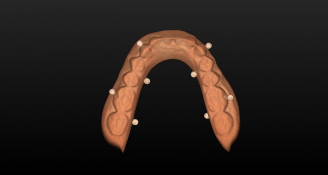 Guided Implant Placement For the Edentulous Arch — Dual Scan Technique JeffLineberry guided implant placement for the edentulous arch dual scan technique Fig.4