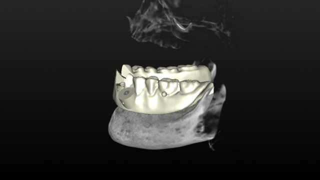 Guided Implant Placement For the Edentulous Arch — Dual Scan Technique JeffLineberry guided implant placement for the edentulous arch dual scan technique Fig.5