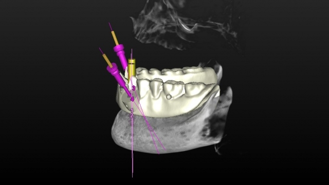 Guided Implant Placement For the Edentulous Arch — Dual Scan Technique JeffLineberry guided implant placement for the edentulous arch dual scan technique Fig.6