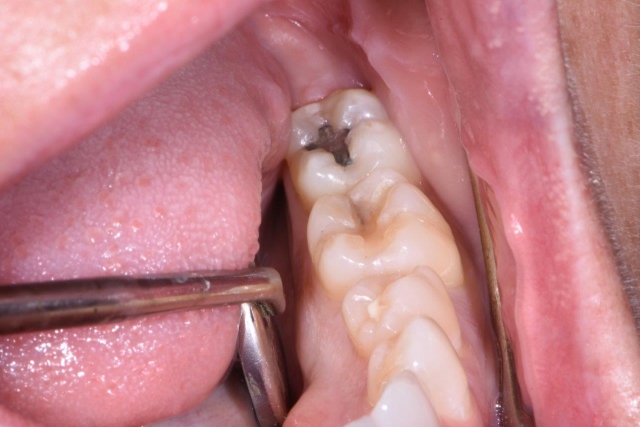 What Are Treatment Options for the Cracked Tooth? JeffLineberry what are treatment options for the cracked tooth Fig.2