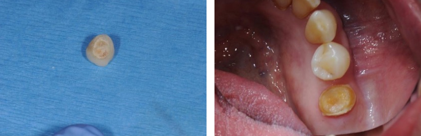 Arg! Another Zirconia Crown Fell Off: A Guide to Recementing Crowns Jeffery Bonk Zirconia Crowns Fig 1