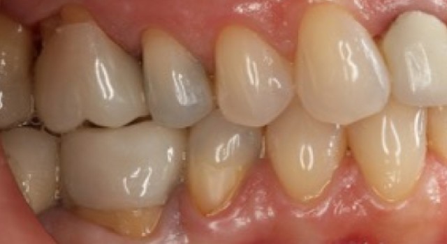 Dental Zirconia: What Type Do I Use?