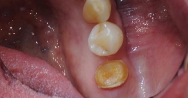 Arg! Another Zirconia Crown Fell Off: A Guide to Recementing Crowns