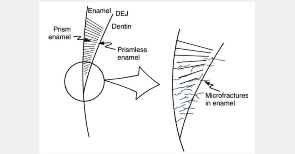 Predictable Ceramic Veneer Margins: Eliminate Unsupported Enamel with ‘Tornado Technique’ JeffreyBonk PredictableCeramicVeneerMargins Fig.1