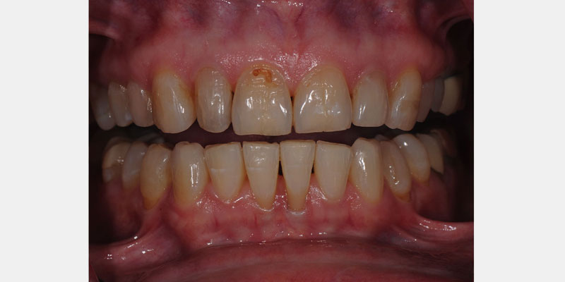 Predictable Ceramic Veneer Margins: Eliminate Unsupported Enamel with ‘Tornado Technique’ JeffreyBonk PredictableCeramicVeneerMargins Fig.2