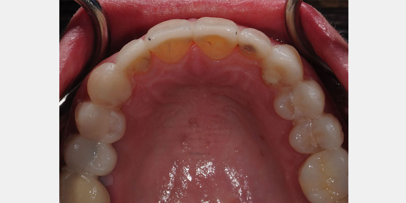 Predictable Ceramic Veneer Margins: Eliminate Unsupported Enamel with ‘Tornado Technique’ JeffreyBonk PredictableCeramicVeneerMargins Fig.3