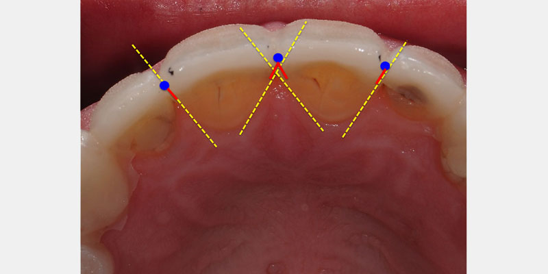Predictable Ceramic Veneer Margins: Eliminate Unsupported Enamel with ‘Tornado Technique’ JeffreyBonk PredictableCeramicVeneerMargins Fig.4