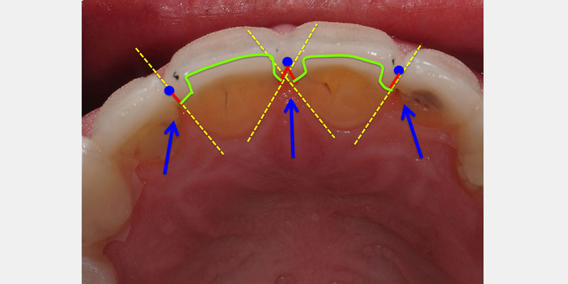 Predictable Ceramic Veneer Margins: Eliminate Unsupported Enamel with ‘Tornado Technique’ JeffreyBonk PredictableCeramicVeneerMargins Fig.5