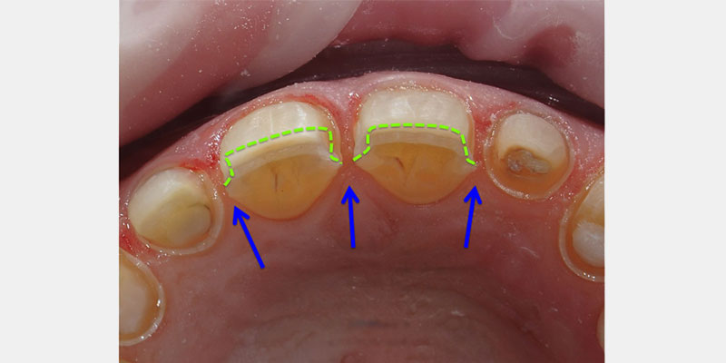 Predictable Ceramic Veneer Margins: Eliminate Unsupported Enamel with ‘Tornado Technique’ JeffreyBonk PredictableCeramicVeneerMargins Fig.6