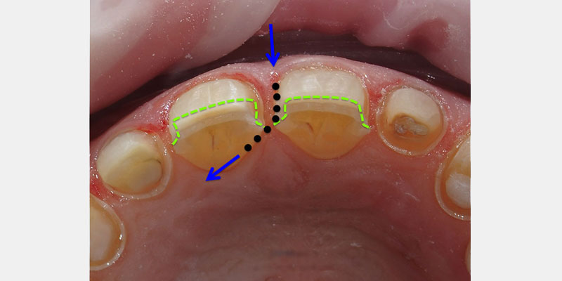 Predictable Ceramic Veneer Margins: Eliminate Unsupported Enamel with ‘Tornado Technique’ JeffreyBonk PredictableCeramicVeneerMargins Fig.8