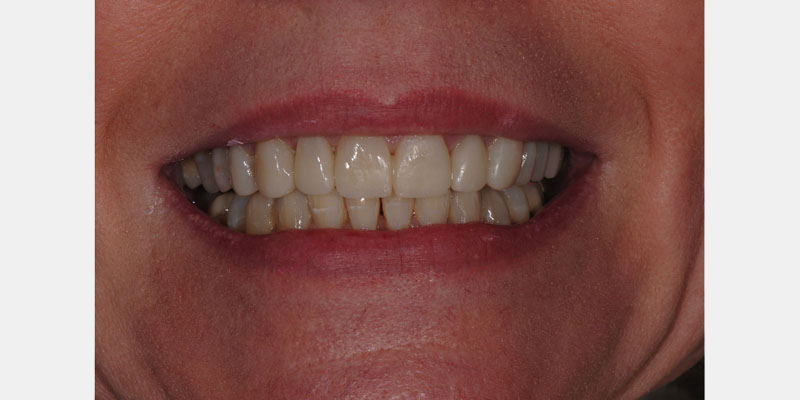 Predictable Ceramic Veneer Margins: Eliminate Unsupported Enamel with ‘Tornado Technique’ JeffreyBonk PredictableCeramicVeneerMargins Fig.9
