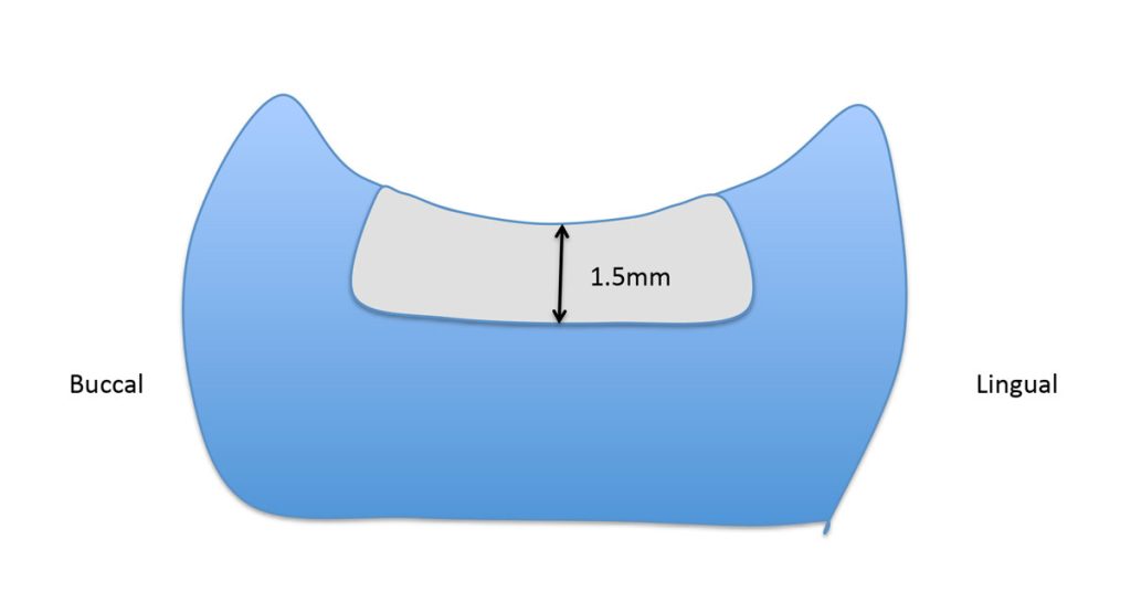 The Ideal ‘Reduction Sauce’ for Restorative Success With Posterior Ceramic Onlays JeffreyBonk ideal reduction for restorative success with posterior ceramic onlays Diag.1