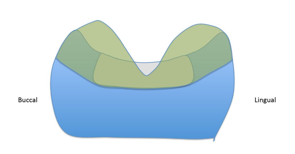 The Ideal ‘Reduction Sauce’ for Restorative Success With Posterior Ceramic Onlays JeffreyBonk ideal reduction for restorative success with posterior ceramic onlays Diag.2