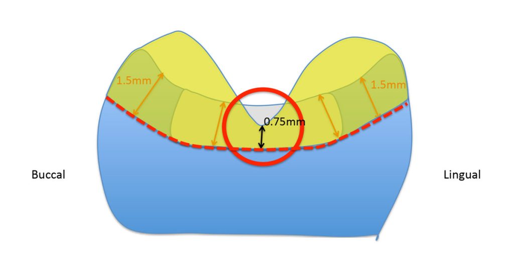 The Ideal ‘Reduction Sauce’ for Restorative Success With Posterior Ceramic Onlays JeffreyBonk ideal reduction for restorative success with posterior ceramic onlays Diag.3