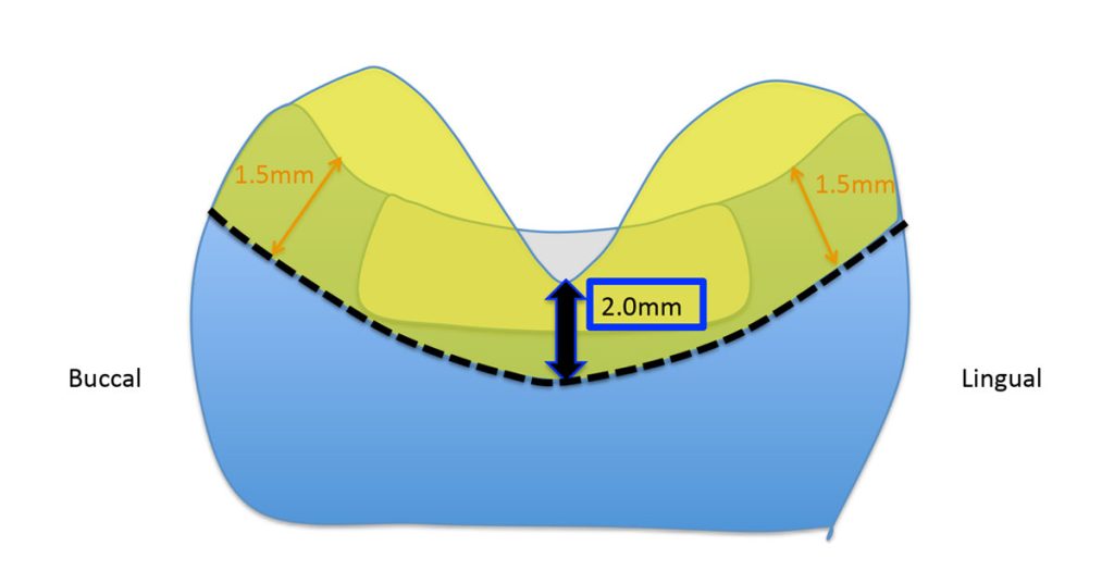 The Ideal ‘Reduction Sauce’ for Restorative Success With Posterior Ceramic Onlays JeffreyBonk ideal reduction for restorative success with posterior ceramic onlays Diag.4