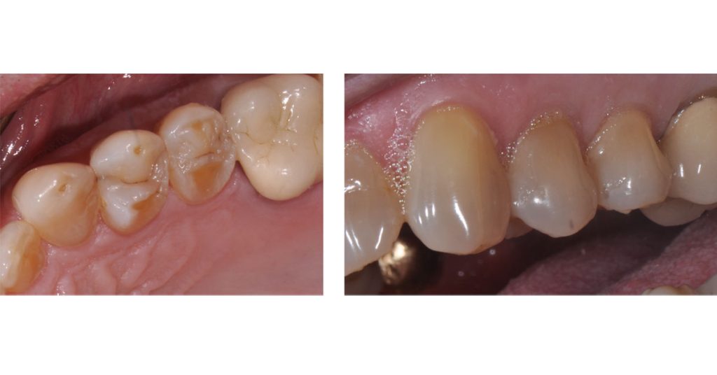 The Ideal ‘Reduction Sauce’ for Restorative Success With Posterior Ceramic Onlays JeffreyBonk ideal reduction for restorative success with posterior ceramic onlays Fig.1