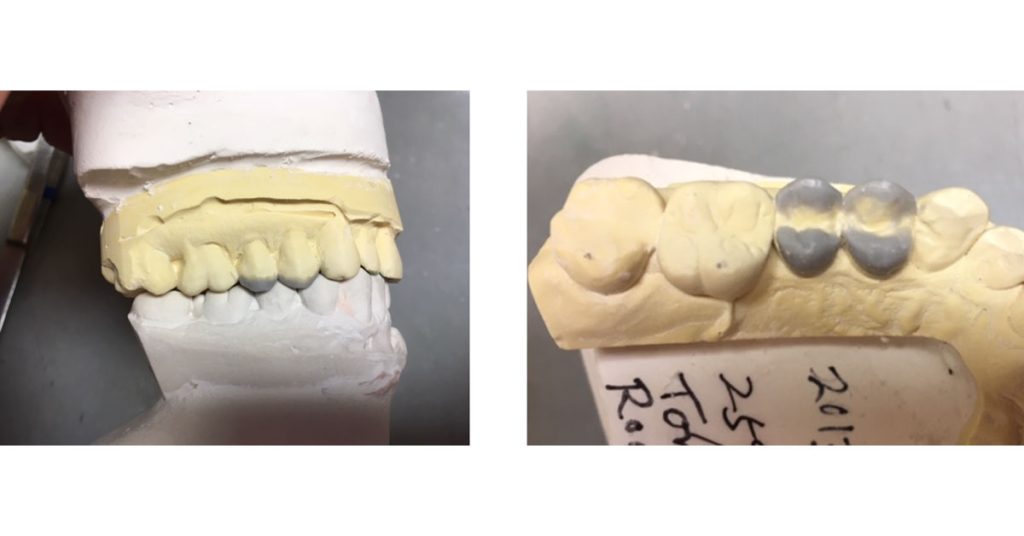 The Ideal ‘Reduction Sauce’ for Restorative Success With Posterior Ceramic Onlays JeffreyBonk ideal reduction for restorative success with posterior ceramic onlays Fig.2