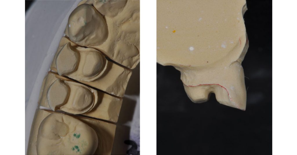 The Ideal ‘Reduction Sauce’ for Restorative Success With Posterior Ceramic Onlays JeffreyBonk ideal reduction for restorative success with posterior ceramic onlays Fig.3