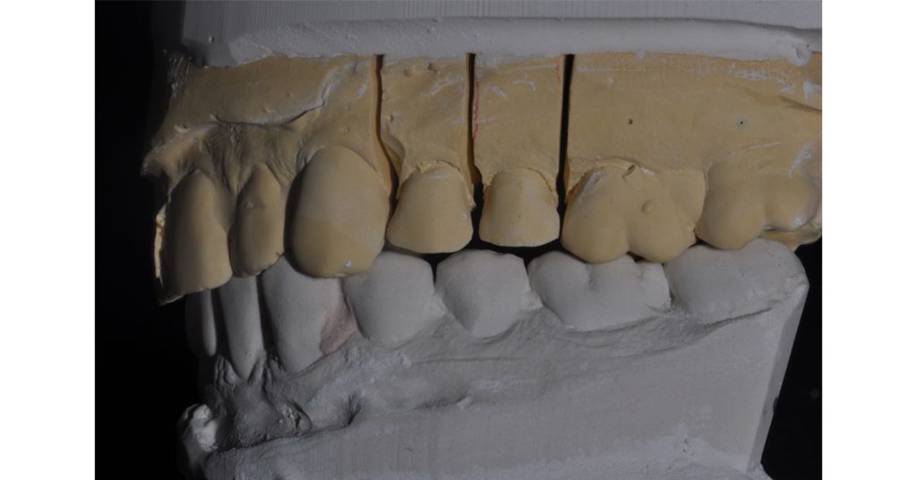 The Ideal ‘Reduction Sauce’ for Restorative Success With Posterior Ceramic Onlays JeffreyBonk ideal reduction for restorative success with posterior ceramic onlays Fig.4