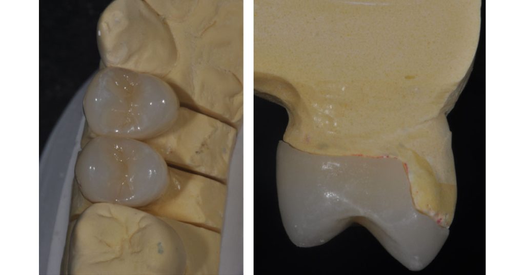 The Ideal ‘Reduction Sauce’ for Restorative Success With Posterior Ceramic Onlays JeffreyBonk ideal reduction for restorative success with posterior ceramic onlays Fig.5