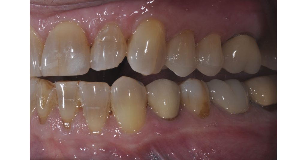 The Ideal ‘Reduction Sauce’ for Restorative Success With Posterior Ceramic Onlays JeffreyBonk ideal reduction for restorative success with posterior ceramic onlays Fig.6