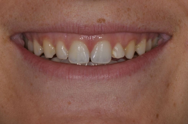 Immediate vs. Delayed Implant Loading JeffreyBonk immediate vs delayed implant loading Fig.1