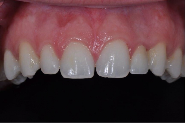 Immediate vs. Delayed Implant Loading JeffreyBonk immediate vs delayed implant loading Fig.11