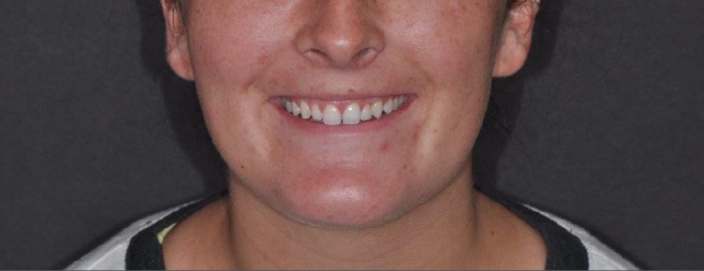 Immediate vs. Delayed Implant Loading JeffreyBonk immediate vs delayed implant loading Fig.12