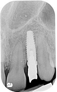Immediate vs. Delayed Implant Loading JeffreyBonk immediate vs delayed implant loading Fig.13