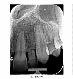 Immediate vs. Delayed Implant Loading JeffreyBonk immediate vs delayed implant loading Fig.2