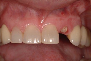 Immediate vs. Delayed Implant Loading JeffreyBonk immediate vs delayed implant loading Fig.3