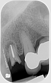 Immediate vs. Delayed Implant Loading JeffreyBonk immediate vs delayed implant loading Fig.4 1