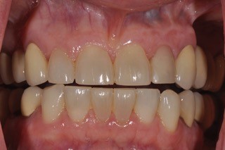 Immediate vs. Delayed Implant Loading JeffreyBonk immediate vs delayed implant loading Fig.5