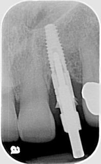 Immediate vs. Delayed Implant Loading JeffreyBonk immediate vs delayed implant loading Fig.6