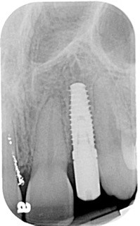 Immediate vs. Delayed Implant Loading JeffreyBonk immediate vs delayed implant loading Fig.7
